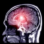 brain tumor treatment by dr aditya bhati